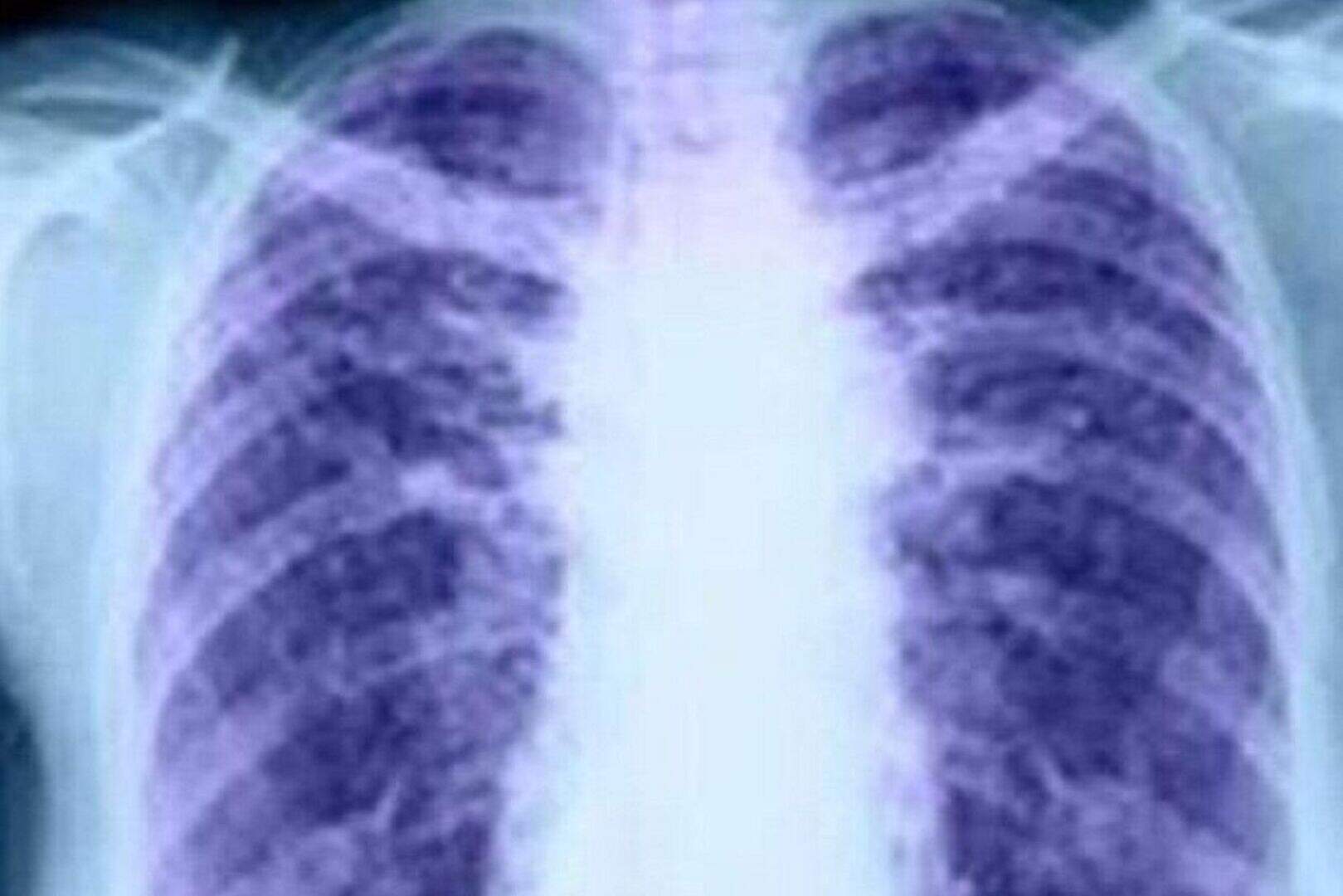 Oxygen in air linked to lung cancer | Belfast Telegraph