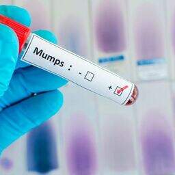 Concerned about the outbreak of mumps? What you need to know | Belfast ...