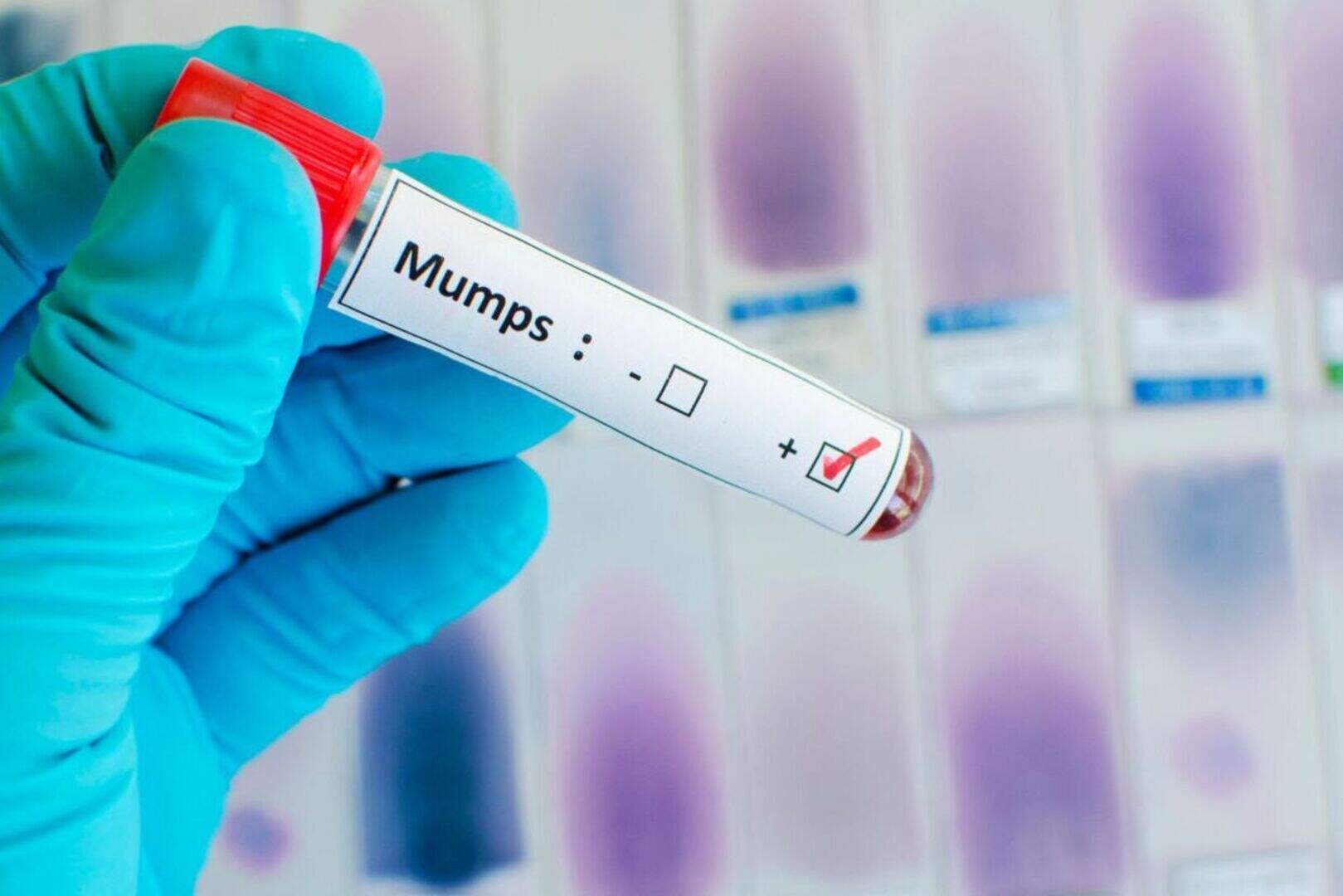 Concerned about the outbreak of mumps? What you need to know | Belfast ...