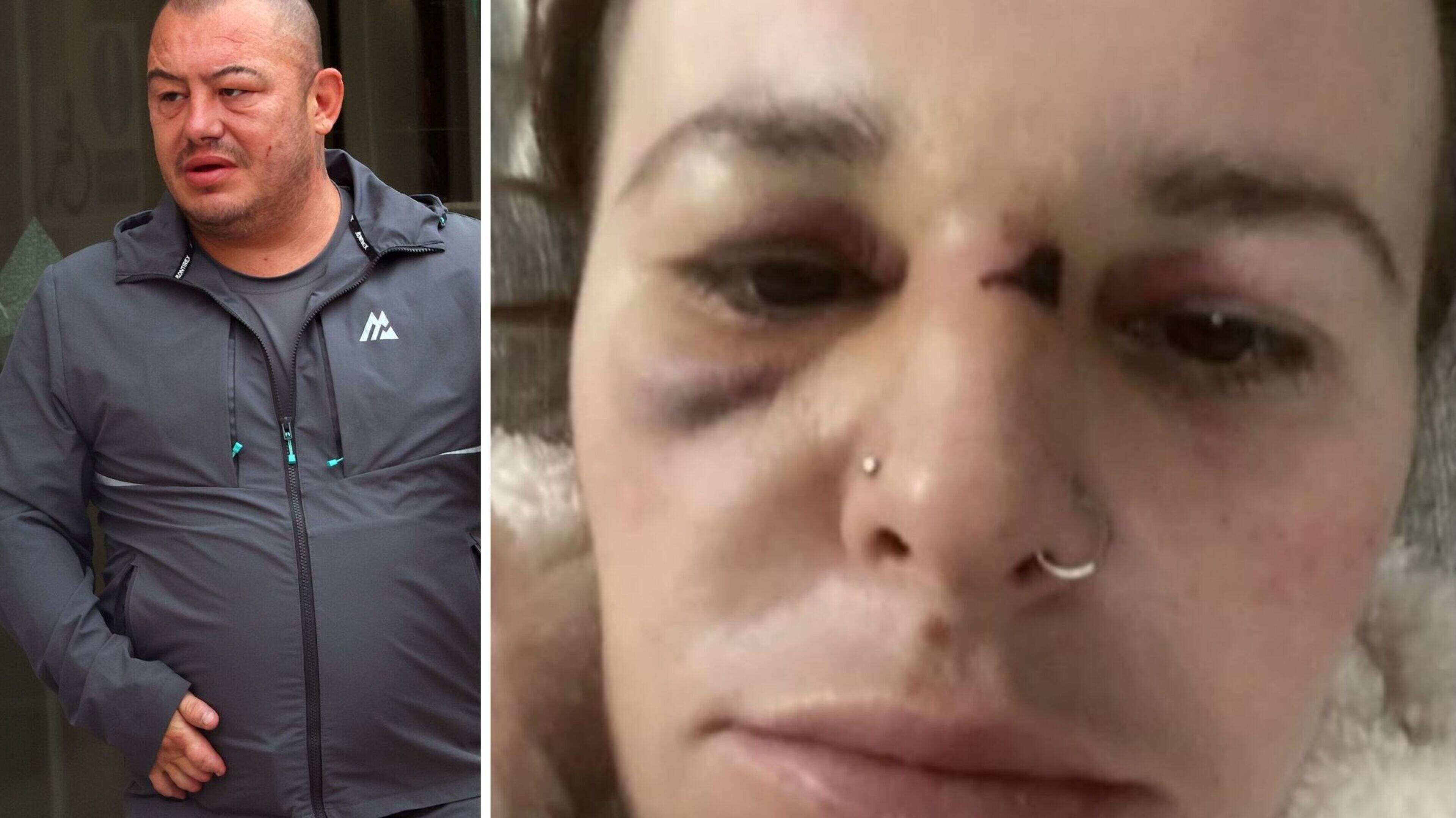 Alleged abuse victim shares horrific injuries after husband charged: ‘My ex tortured me for months... here’s my truth’