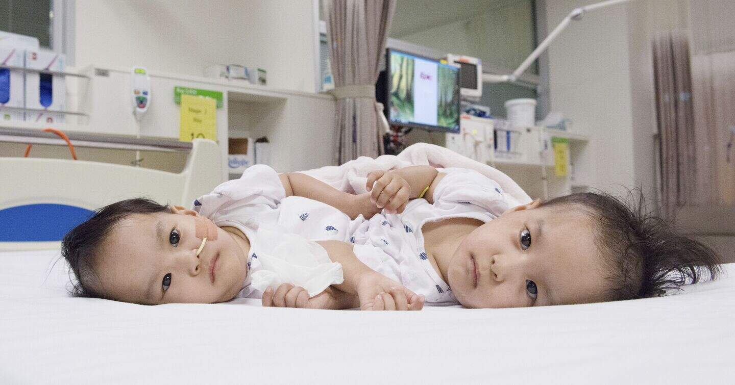Australian surgeons separate conjoined twins from Bhutan | Belfast ...