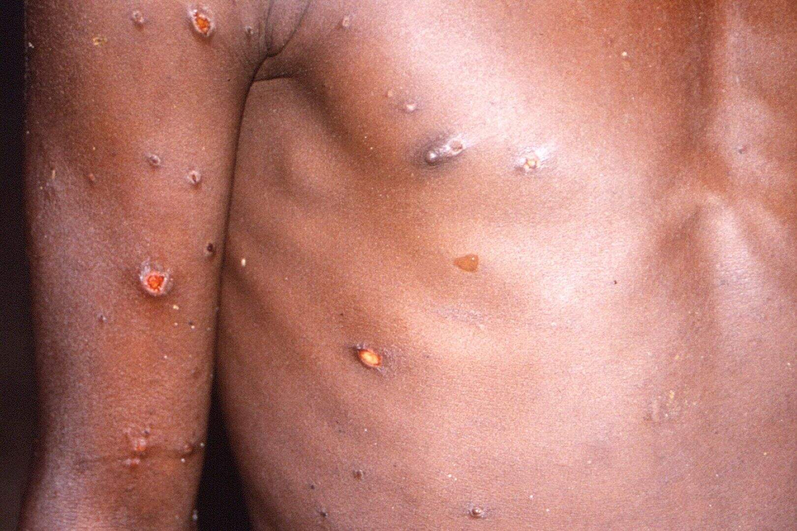Monkeypox renamed ‘because of racism’ | Belfast Telegraph