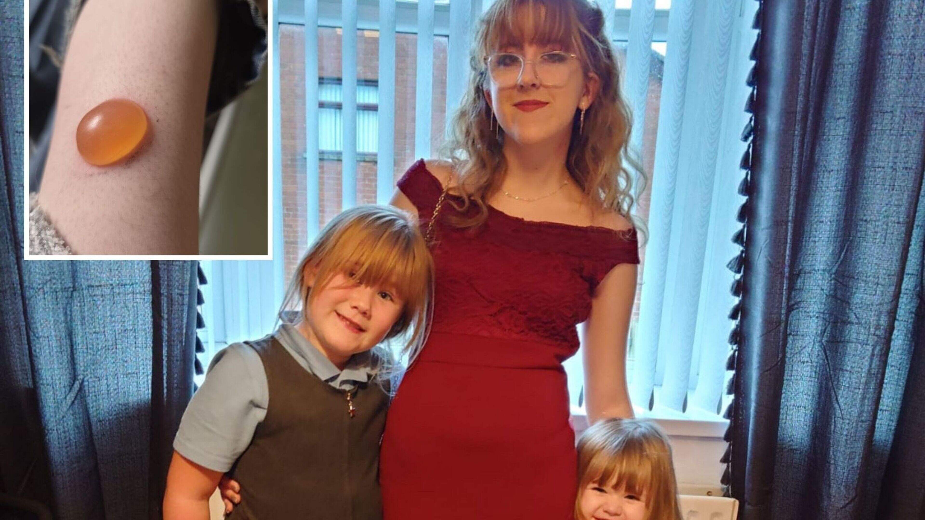Co Antrim teen left with scar and ‘hole in her leg’ after suspected spider bite in home