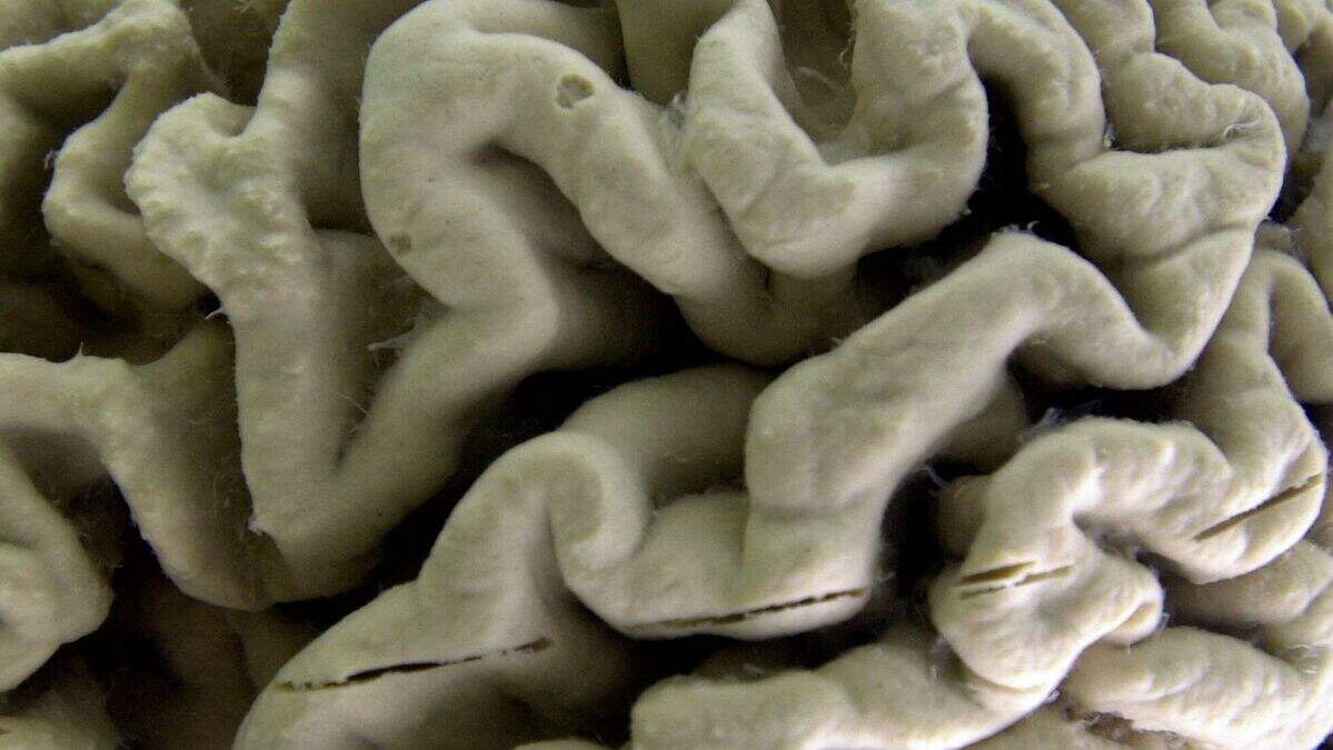 US approves Alzheimer’s drug that can slow disease’s progress | Belfast ...