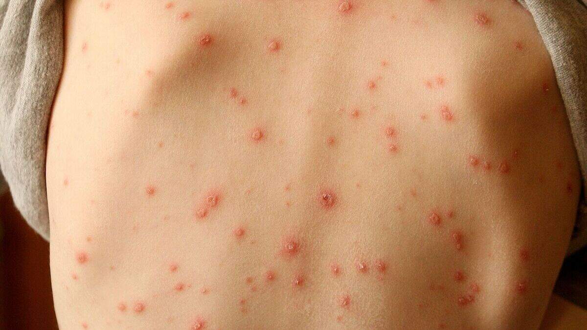 Skin rash should be considered key symptom of coronavirus, say ...