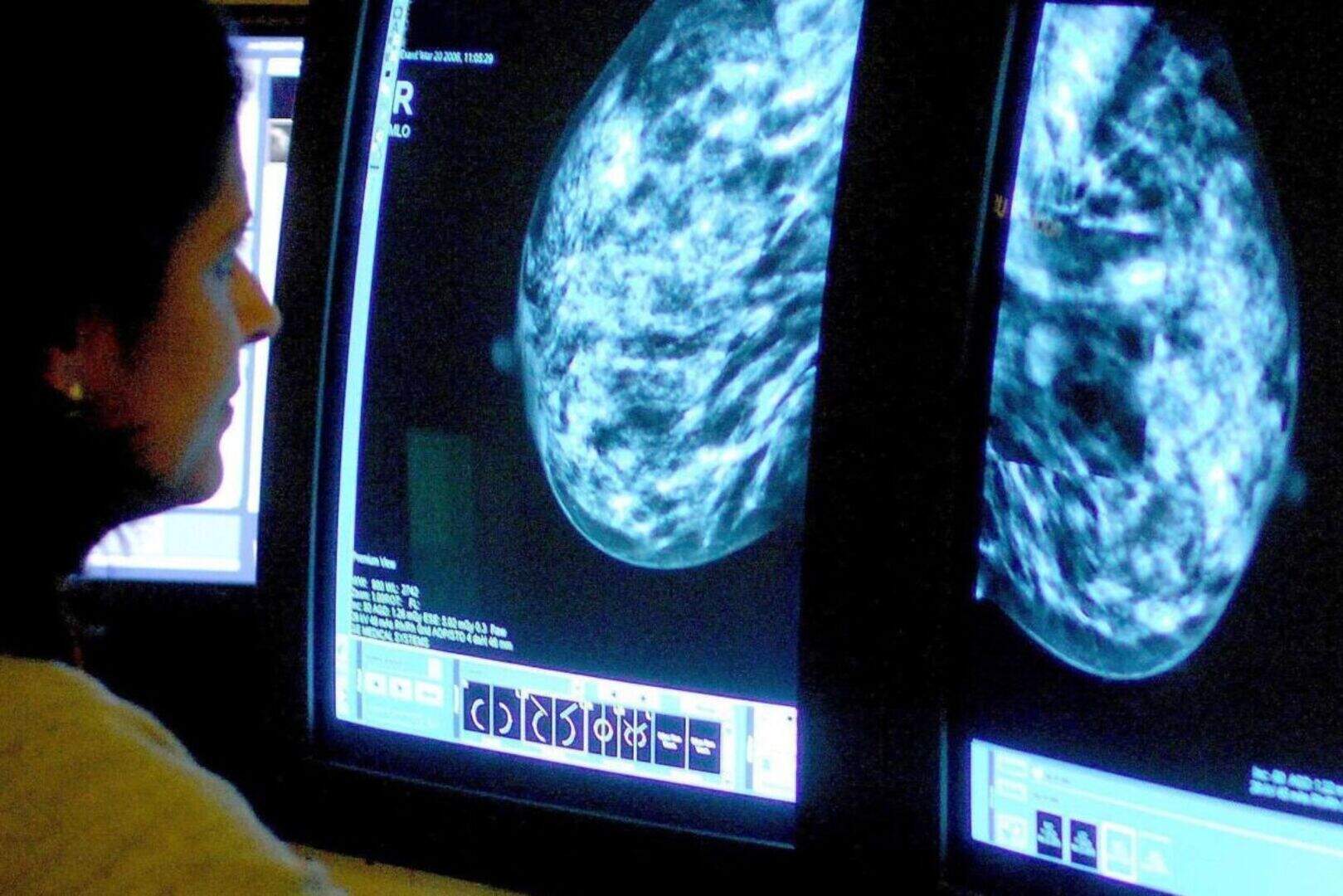 Targeted radiotherapy during surgery cuts breast cancer patients ...
