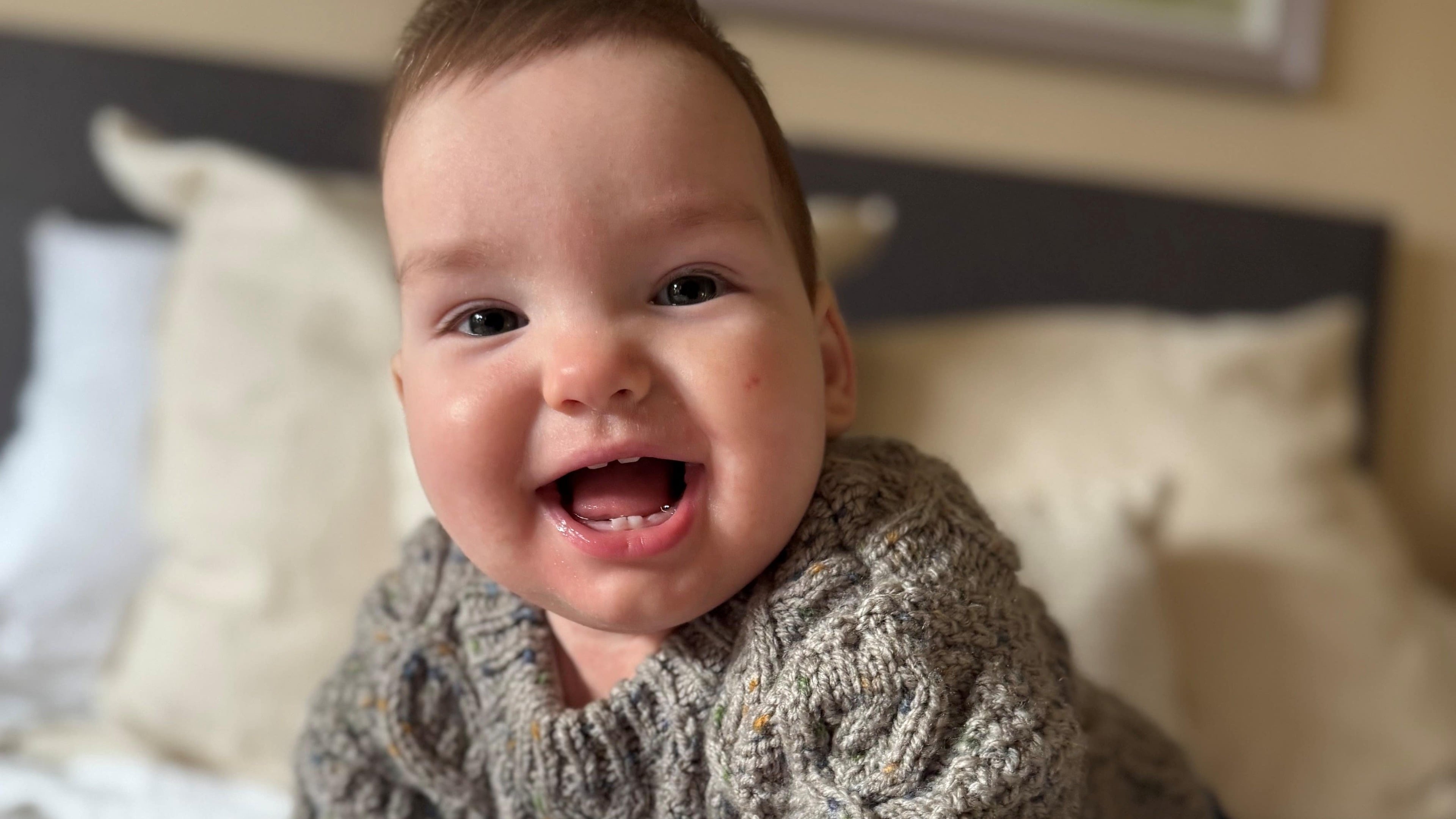 One-year-old Rory Potter receives world-first treatment for rare skull condition