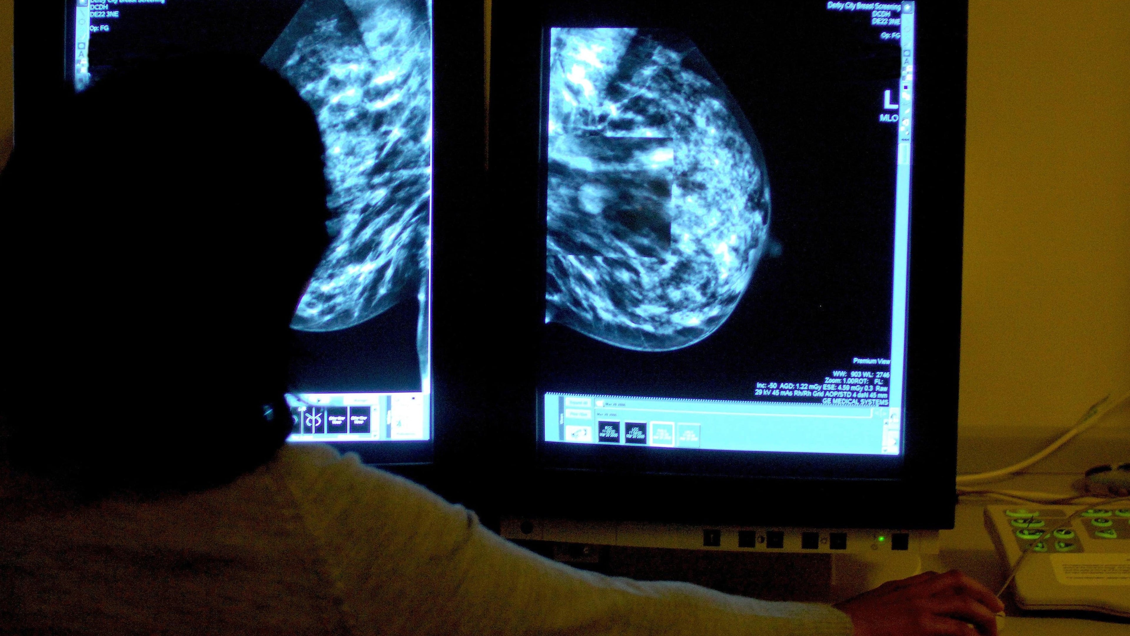 Breast cancer: Women in their 30s and 40s ‘should be warned of alcohol risk’